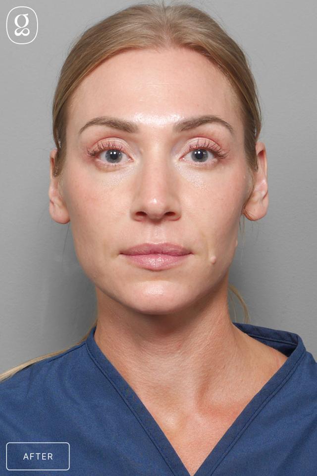Facelift after at Gould Aesthetics in Beverly Hills, CA
