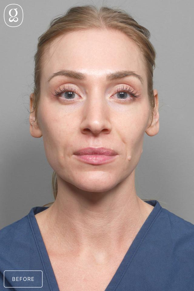 Facelift before at Gould Aesthetics in Beverly Hills, CA
