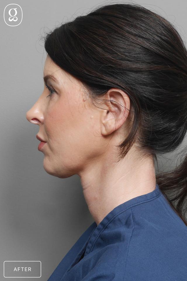Neck Lift after at Gould Aesthetics in Beverly Hills, CA