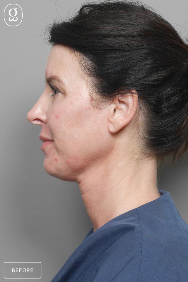 Neck Lift before at Gould Aesthetics in Beverly Hills, CA