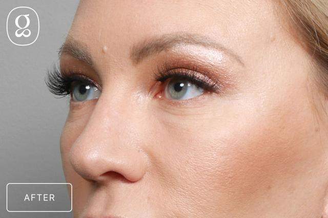 Brow Lift after at Gould Aesthetics in Beverly Hills, CA