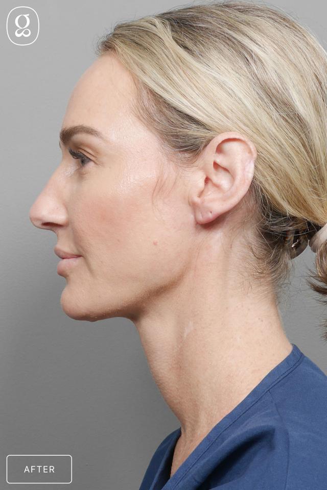 Neck Lift after at Gould Aesthetics in Beverly Hills, CA