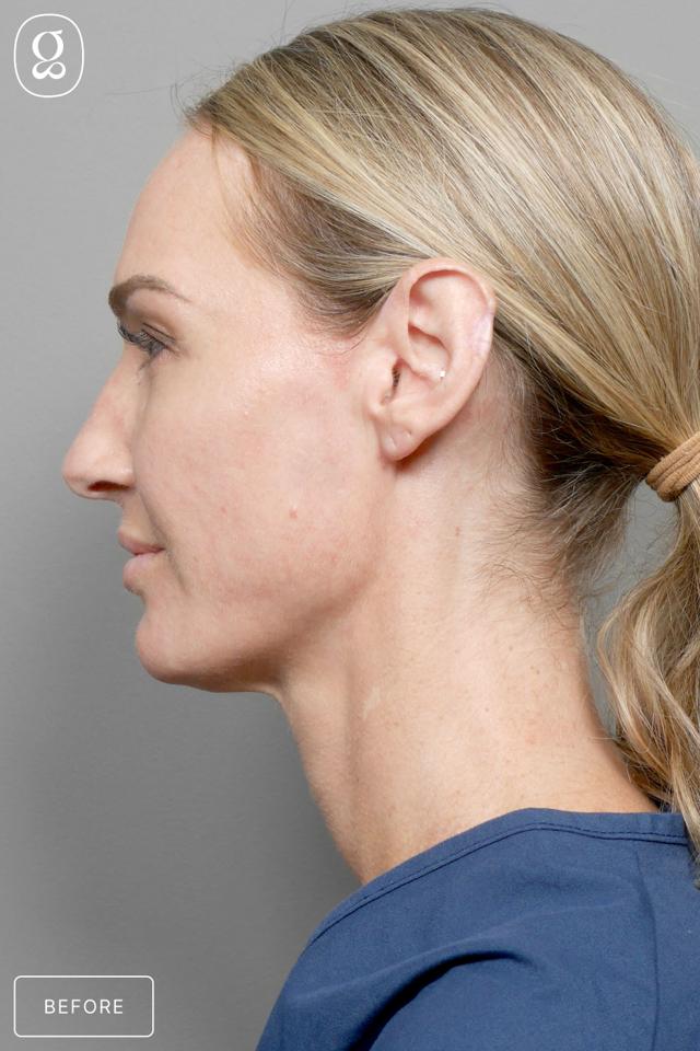 Neck Lift before at Gould Aesthetics in Beverly Hills, CA