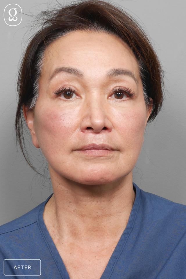 Facelift after at Gould Aesthetics in Beverly Hills, CA