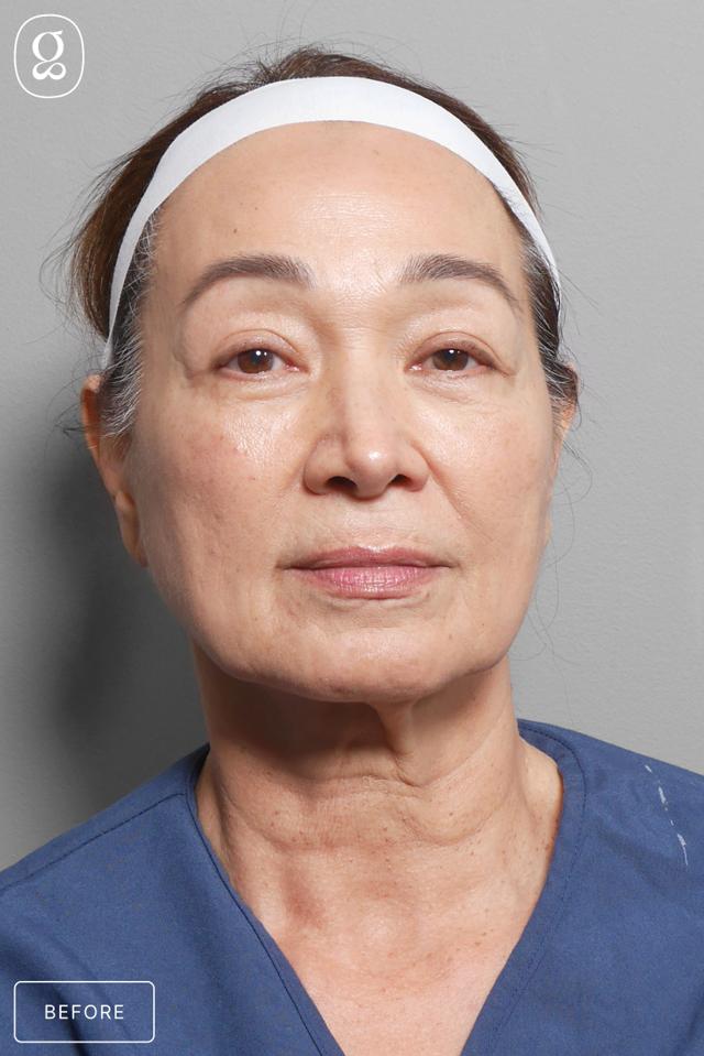 Facelift before at Gould Aesthetics in Beverly Hills, CA
