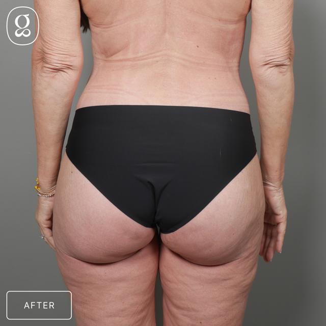 Fat Transfer after at Gould Aesthetics in Beverly Hills, CA