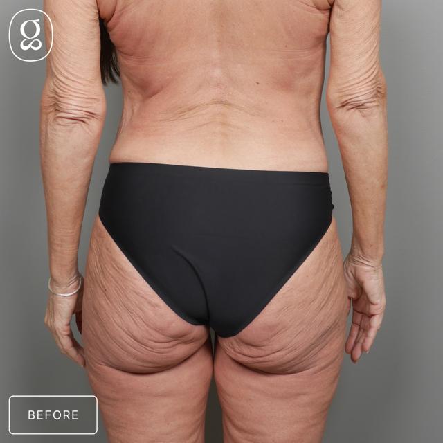 Fat Transfer before at Gould Aesthetics in Beverly Hills, CA