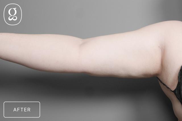 Liposuction after at Gould Aesthetics in Beverly Hills, CA