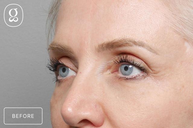 Brow Lift before at Gould Aesthetics in Beverly Hills, CA