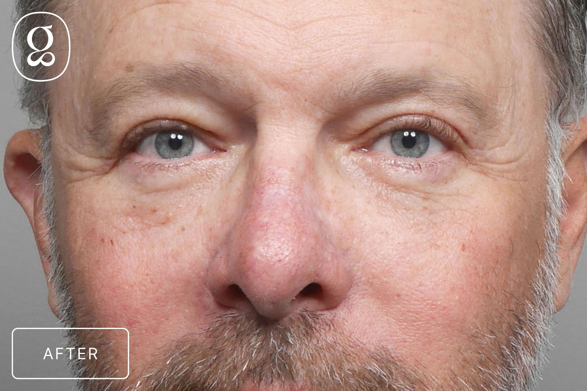 Gould Aesthetics eyelid lift after — Beverly Hills, CA