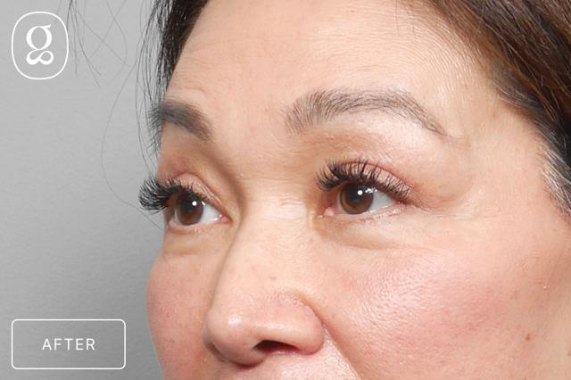 Brow Lift after at Gould Aesthetics in Beverly Hills, CA
