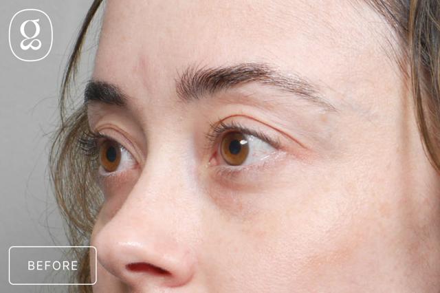 Brow Lift before at Gould Aesthetics in Beverly Hills, CA