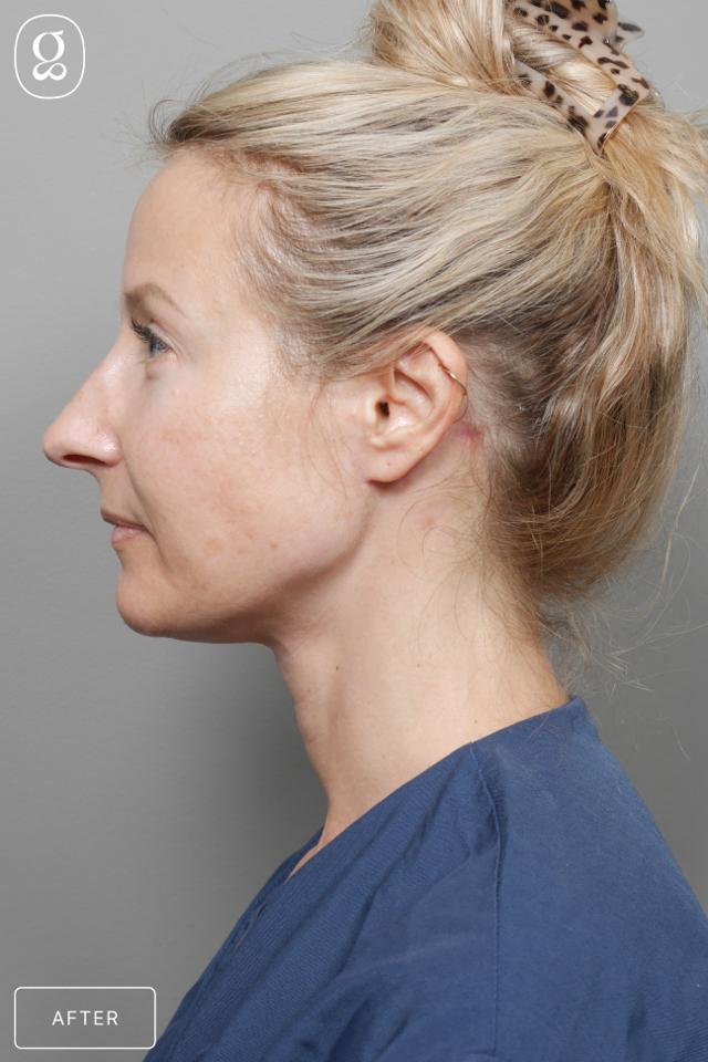 Neck Lift after at Gould Aesthetics in Beverly Hills, CA
