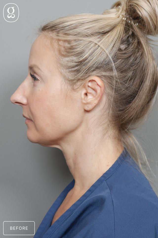 Neck Lift before at Gould Aesthetics in Beverly Hills, CA