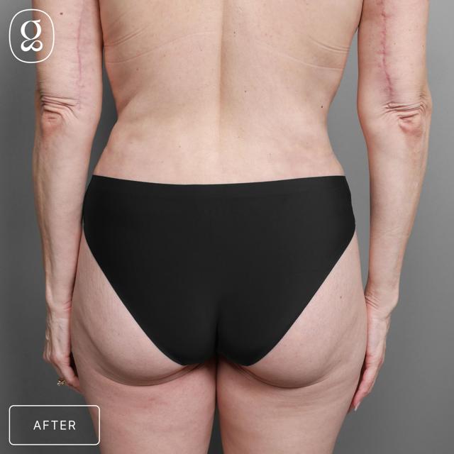 Fat Transfer after at Gould Aesthetics in Beverly Hills, CA