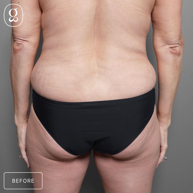 Fat Transfer before at Gould Aesthetics in Beverly Hills, CA