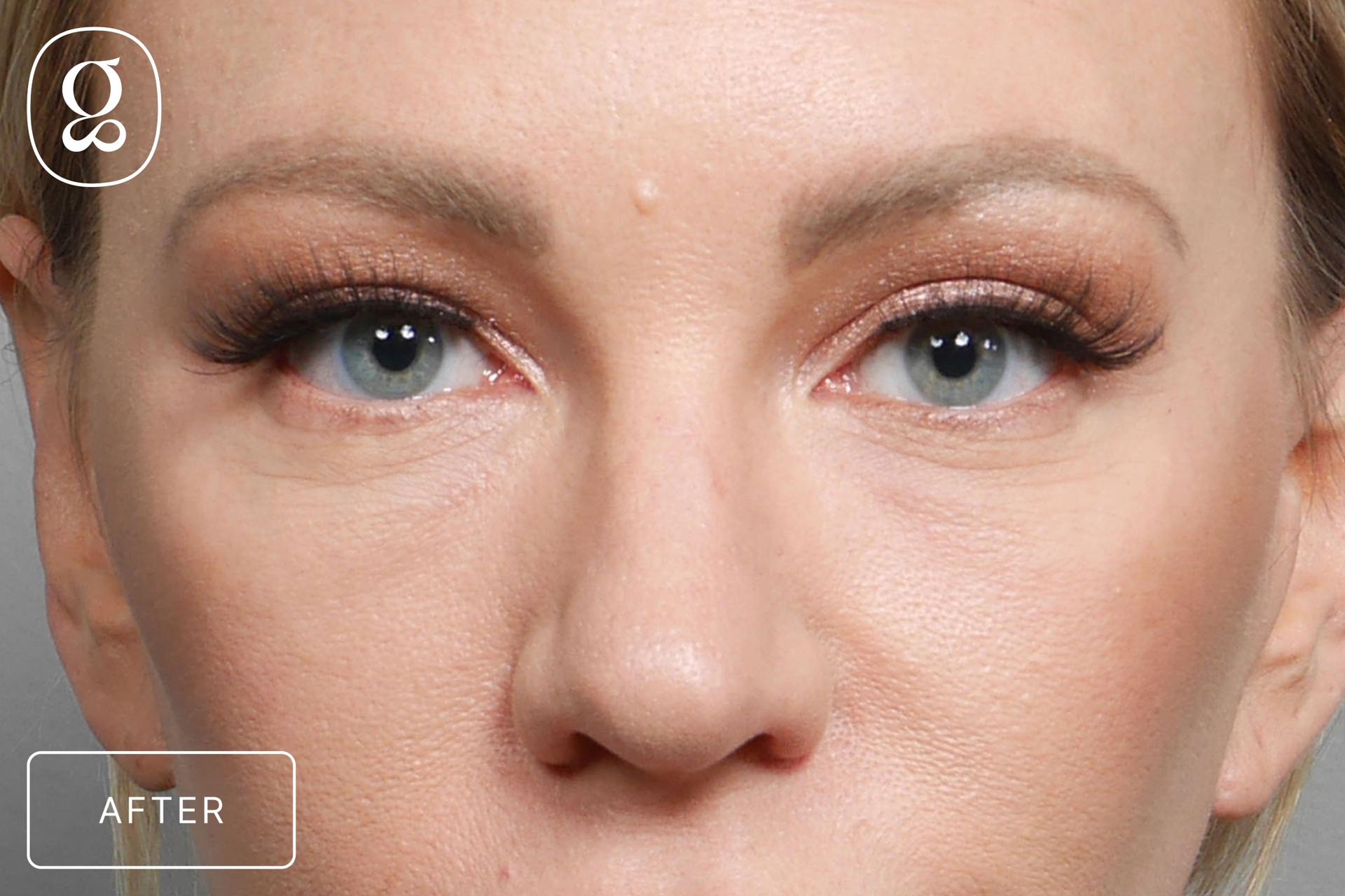 Gould Aesthetics eyelid lift after — Beverly Hills, CA