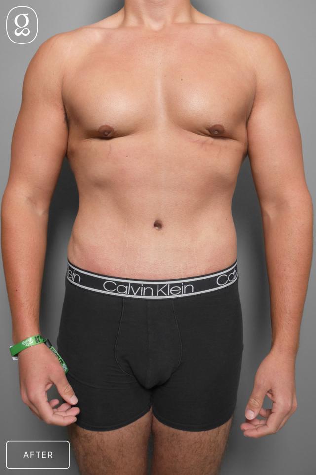 Gynecomastia Surgery after at Gould Aesthetics in Beverly Hills, CA