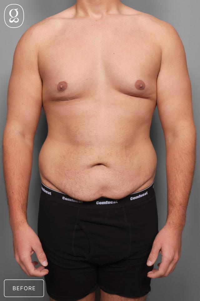 Gynecomastia Surgery before at Gould Aesthetics in Beverly Hills, CA