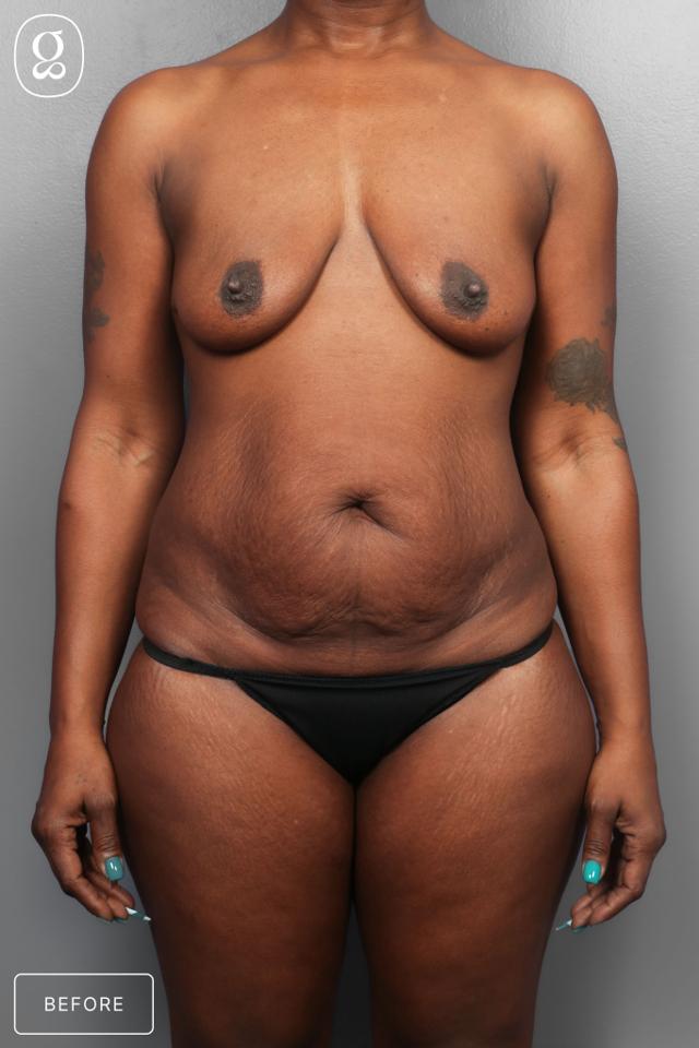 Tummy Tuck before at Gould Aesthetics in Beverly Hills, CA
