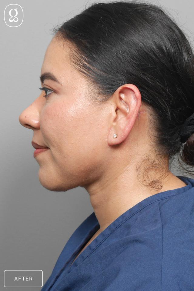 Neck Lift after at Gould Aesthetics in Beverly Hills, CA