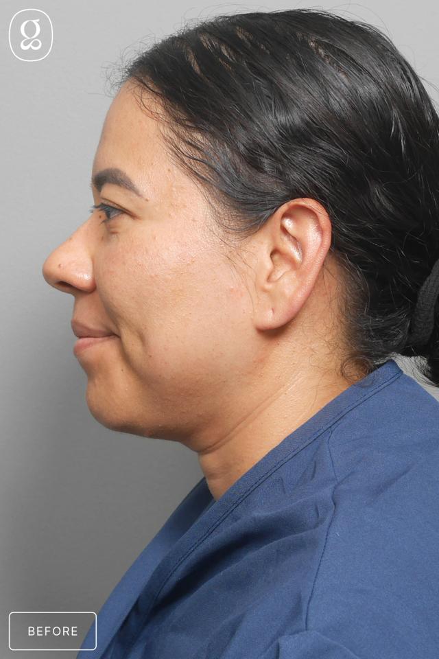 Neck Lift before at Gould Aesthetics in Beverly Hills, CA
