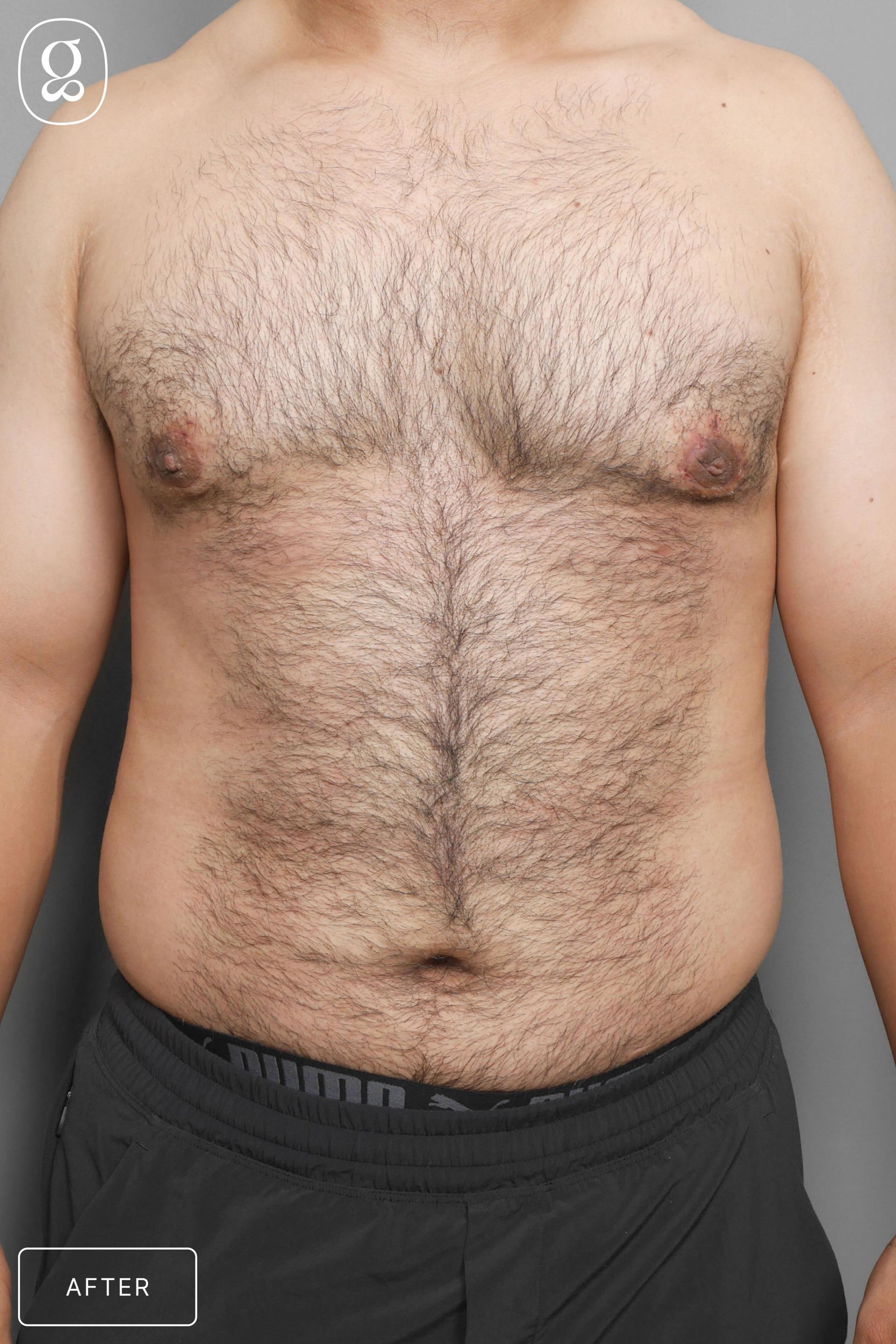 Gould Aesthetics gynecomastia after — Beverly Hills, CA