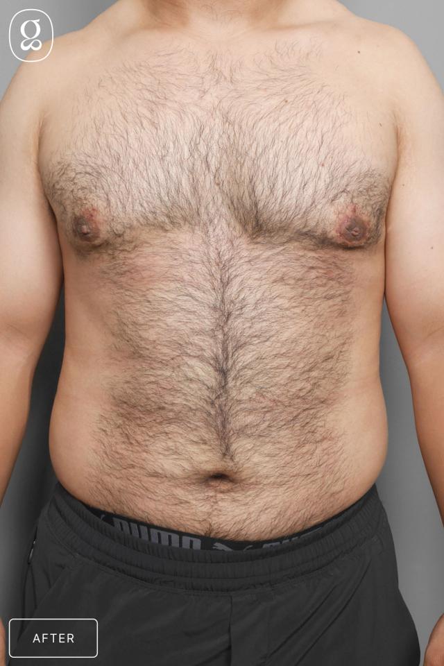 Gynecomastia Surgery after at Gould Aesthetics in Beverly Hills, CA