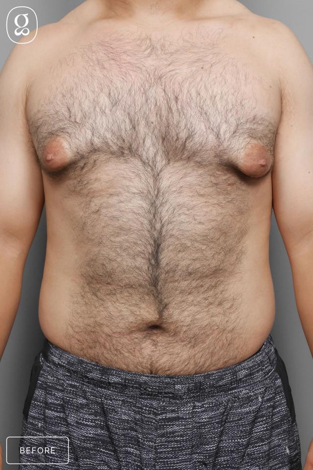 Gynecomastia Surgery before at Gould Aesthetics in Beverly Hills, CA