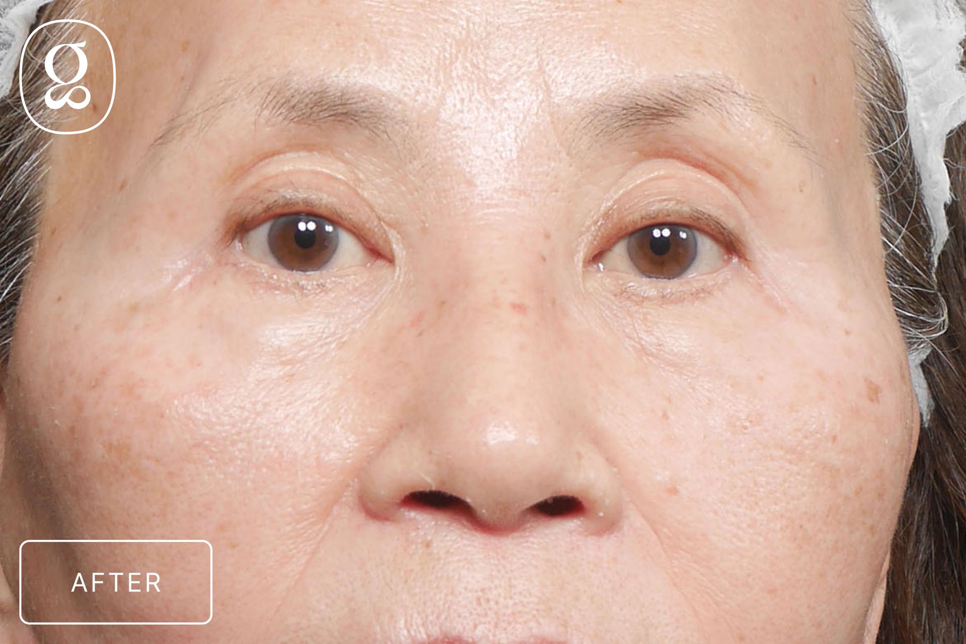 Gould Aesthetics eyelid lift after — Beverly Hills, CA