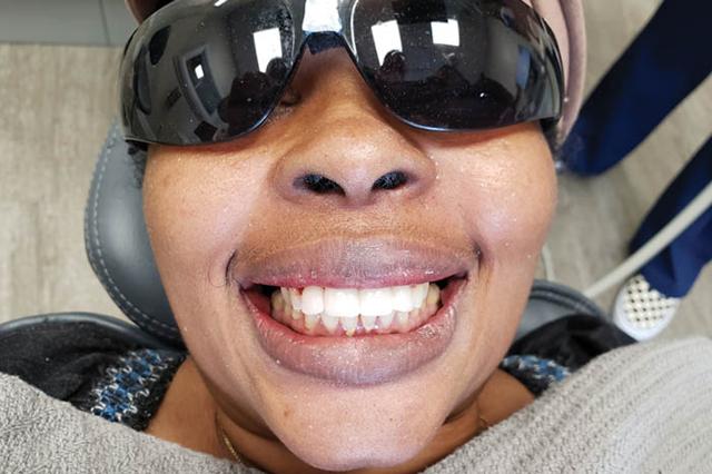 Dental Implants after at Holladay Smiles in Salt Lake City, UT
