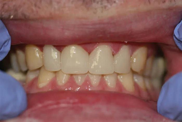 Holladay Smiles smile makeover after — Salt Lake City, UT