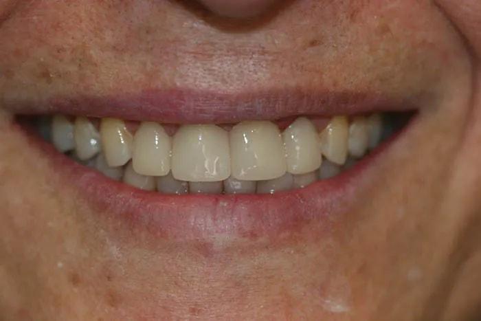 Holladay Smiles smile makeover after — Salt Lake City, UT