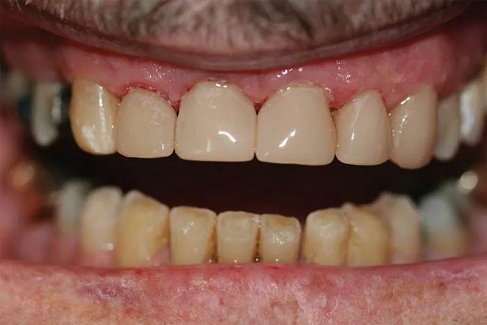 Holladay Smiles smile makeover after — Salt Lake City, UT