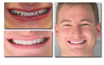 Holladay Smiles result — Salt Lake City, UT