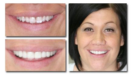 Holladay Smiles result — Salt Lake City, UT