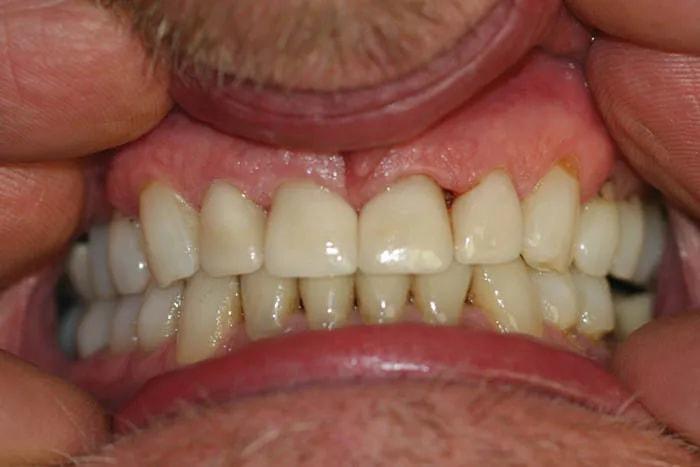 Holladay Smiles smile makeover after — Salt Lake City, UT