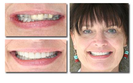 Dental Veneers result at Holladay Smiles in Salt Lake City, UT