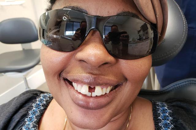 Dental Implants before at Holladay Smiles in Salt Lake City, UT