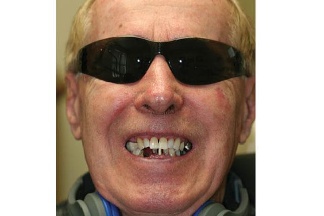 Dental Implants before at Holladay Smiles in Salt Lake City, UT