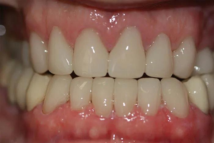 Holladay Smiles smile makeover after — Salt Lake City, UT