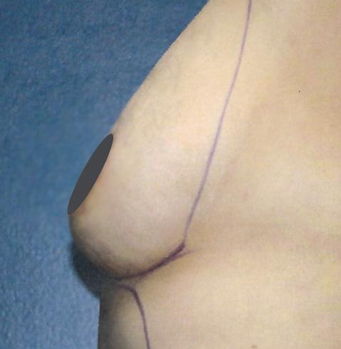 Dr. Tambra R. Garrett, MD, Fort Worth breast augmentation after — Fort Worth, TX