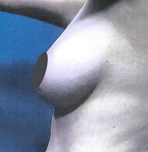 Breast Augmentation before at Dr. Tambra R. Garrett, MD, Fort Worth in Fort Worth, TX