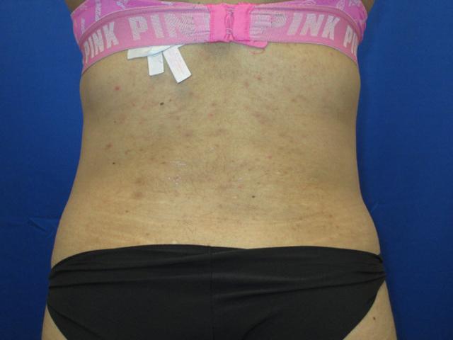 Dr. Tambra R. Garrett, MD, Fort Worth fat transfer after — Fort Worth, TX