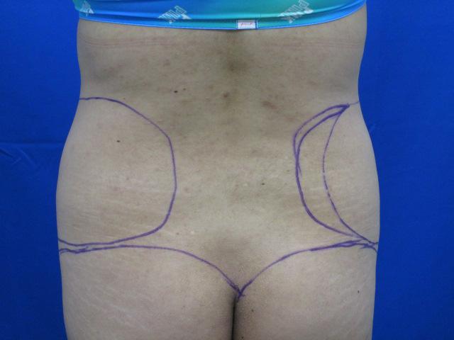 Fat Transfer before at Dr. Tambra R. Garrett, MD, Fort Worth in Fort Worth, TX