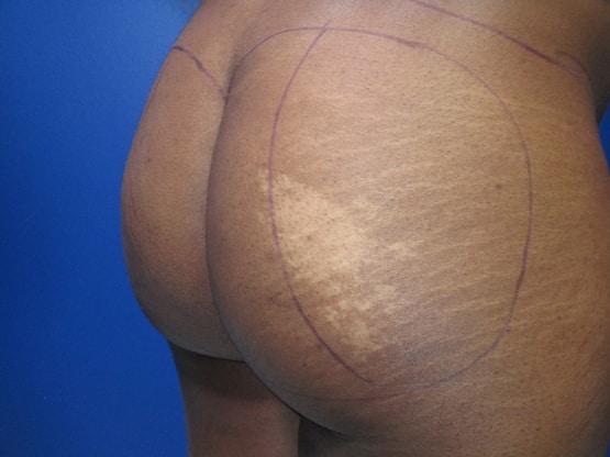 Brazilian Butt Lift before at Dr. Tambra R. Garrett, MD, Fort Worth in Fort Worth, TX