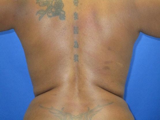 Dr. Tambra R. Garrett, MD, Fort Worth liposuction after — Fort Worth, TX