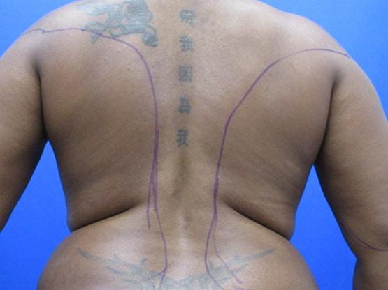 Liposuction before at Dr. Tambra R. Garrett, MD, Fort Worth in Fort Worth, TX