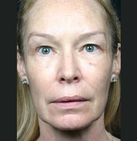 Facelift after at Dr. Tambra R. Garrett, MD, Fort Worth in Fort Worth, TX