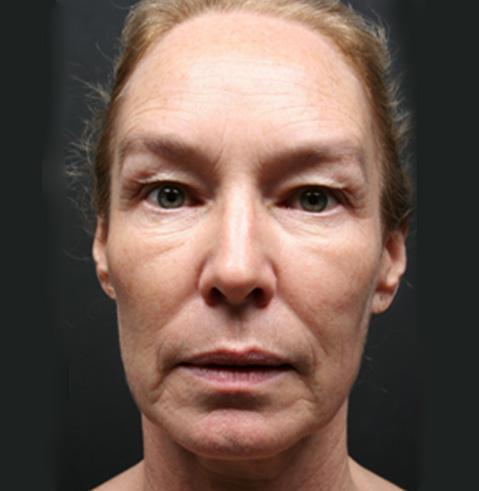 Facelift before at Dr. Tambra R. Garrett, MD, Fort Worth in Fort Worth, TX